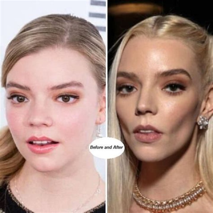 Truth about Anya Taylor-Joys Plastic Surgery Rumors| Her Beauty Treatment Based on Quotes & Photo